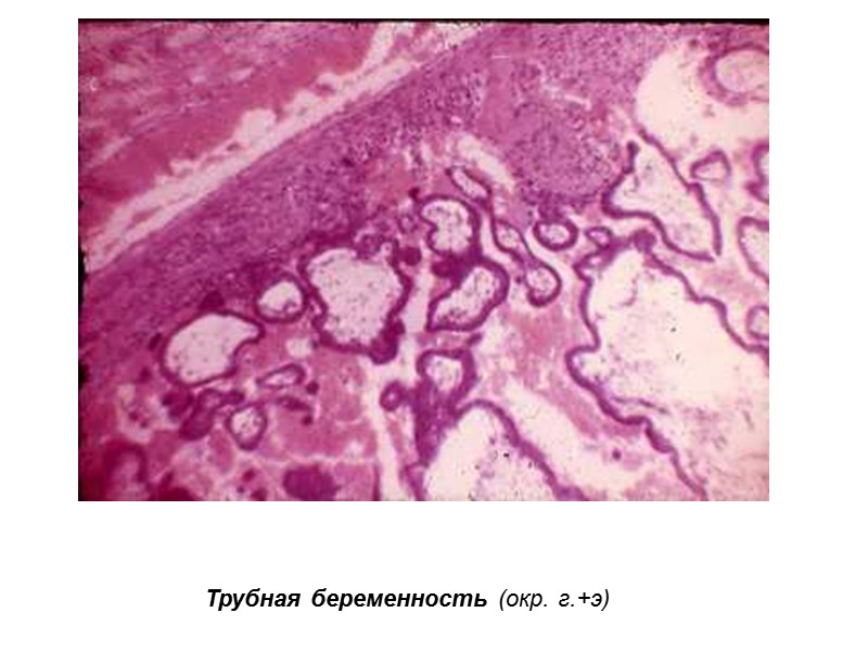 Трубная беременность (окр. г.+э)
